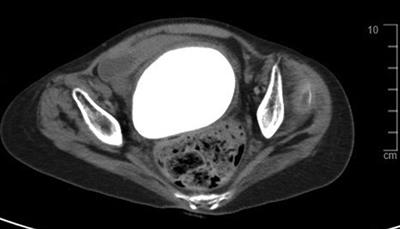 Huge vaginal stone: Case report and review of the literature